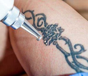 Dr. Roger Koreen explains Possible side effects of laser tattoo removal
