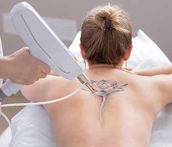 Laser Tattoo Removal Huntington NY - Is Laser Tattoo Removal Worth It