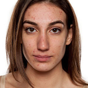 Girl with acne on her face