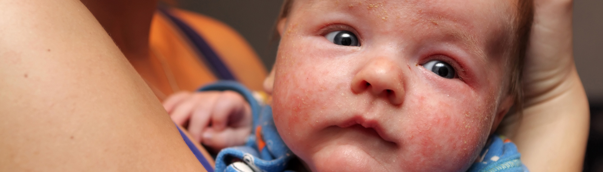 The baby has eczema on his face
