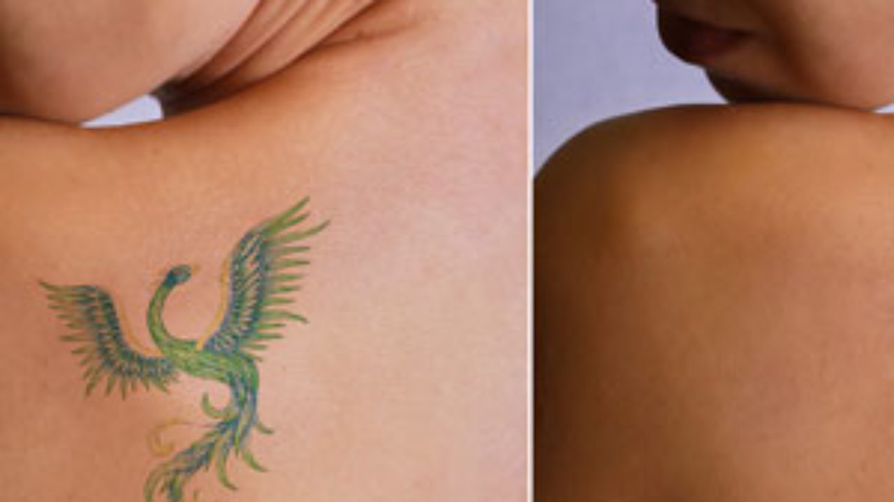 Safe Laser Tattoo Removal in Huntington NY | PicoSure Treatment | Dr Roger  Koreen