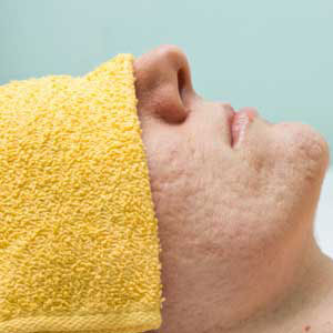 Microdermabrasion for acne scars is available in Huntington NY