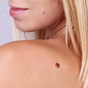 Young woman with birthmark