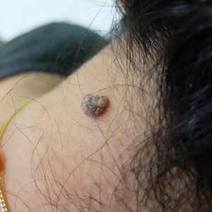 Mole on the back of neck