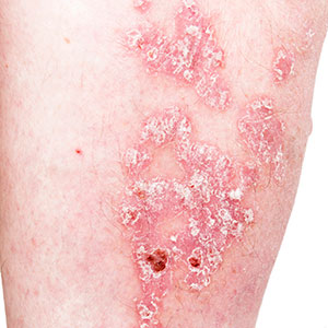Psoriatic Skin Disease