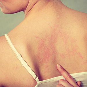 Women shaving, skin rashes on her back