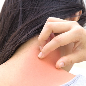 A woman having a skin rash itch on the neck