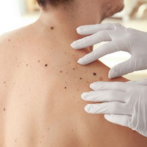 Melanoma and other skin cancer treatment available from your Huntington Dermatologist