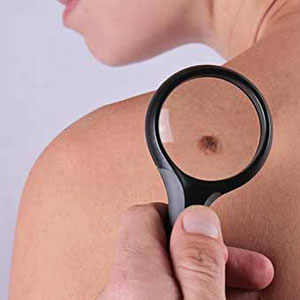 Dermatologist doctor checking skin cancer
