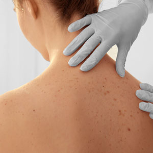 Skin cancer treatment from your Huntington, NY dermatologist is designed for optimal results