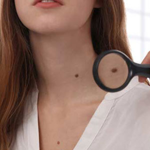 Huntington, NY doctor explains why there has been an increase in instances of skin cancer