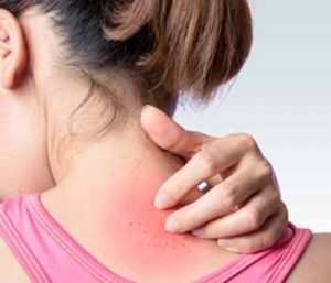Young woman scratching upper back or neck rash