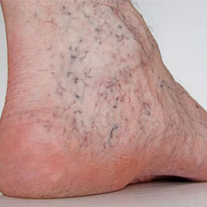 Sclerotherapy treatments can reduce visible veins in the legs