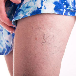 Varicose veins on man's leg