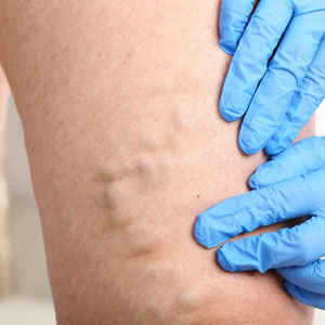 Addressing myths about types of leg veins and sclerotherapy treatments in Huntington, NY