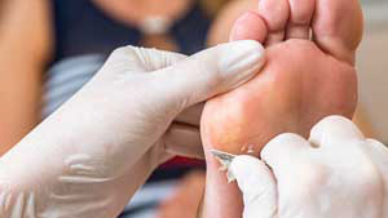 Wart removal foot doctor Wart treatment foot