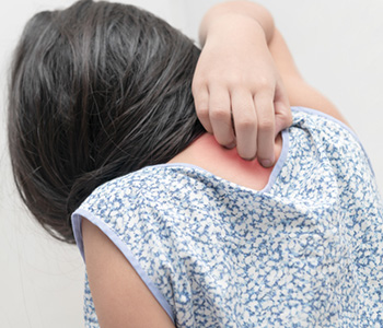 A girl having rashes on her back