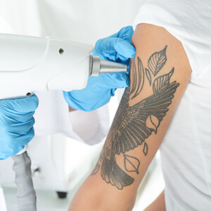 In Huntington Area Patients Wonder, "Does Laser Tattoo Removal Cause Cancer?"