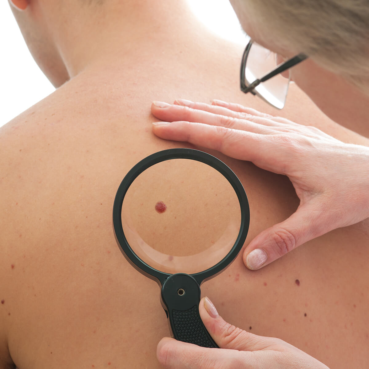 Mole Removal Methods at Dermatology & Cosmetic Laser Center in Huntington NY Area
