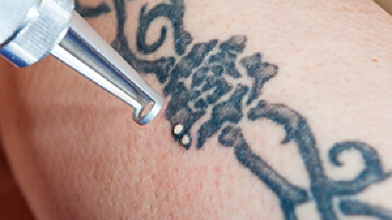 Picosure Tattoo Removal Aftercare In Huntington NY