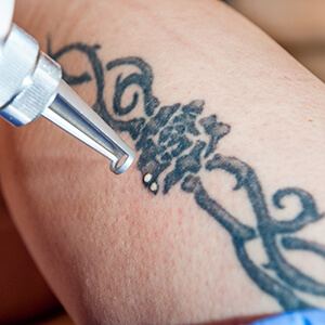 Picosure Tattoo Removal in Huntington NY Area