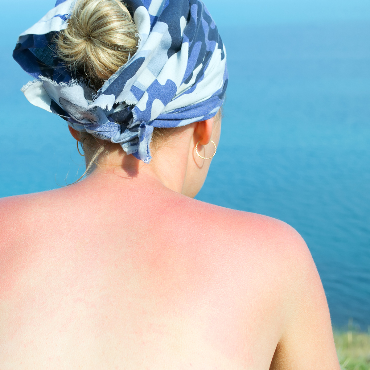 How to prevent sun damage and treatment for sun-damaged skin